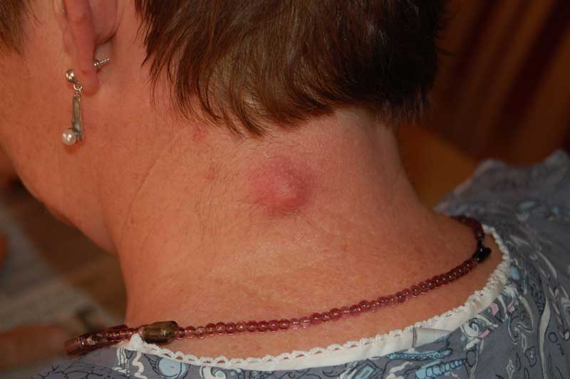楊浩康(Yeung Ho Hong)醫生講解Epidermoid cyst