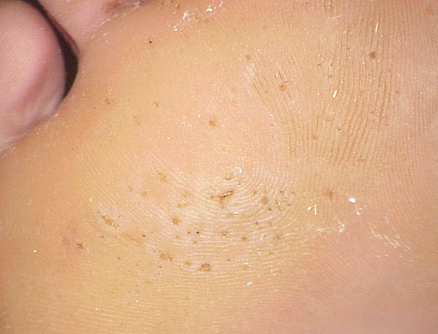 楊浩康(Yeung Ho Hong)醫生講解Pitted Keratolysis (凹陷性角質溶解症)