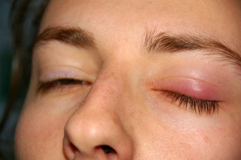 楊浩康(Yeung Ho Hong)醫生講解霰粒腫(Chalazion)