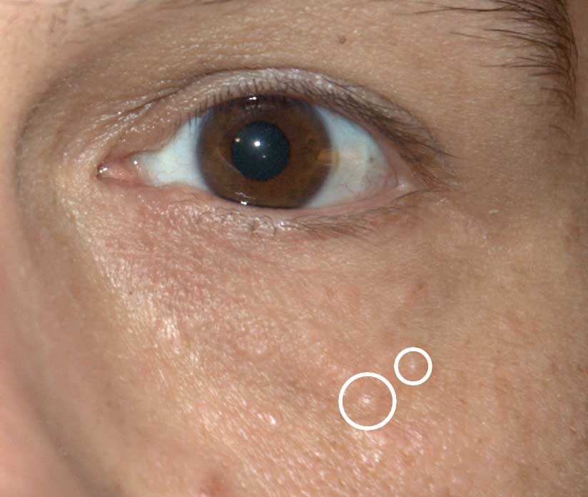 楊浩康(Yeung Ho Hong)醫生講解汗管瘤是甚麼(Syringomas)